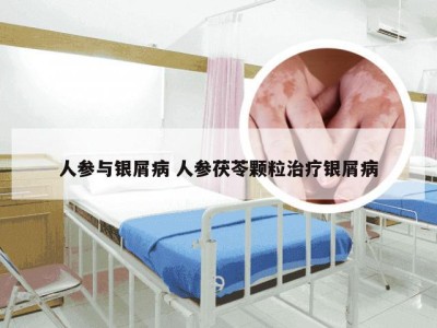 人参与银屑病 人参茯苓颗粒治疗银屑病