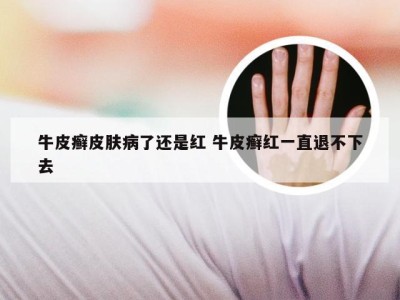 牛皮癣皮肤病了还是红 牛皮癣红一直退不下去