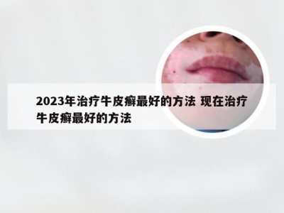 2023年治疗牛皮癣最好的方法 现在治疗牛皮癣最好的方法