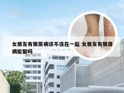 女朋友有银屑病该不该在一起 女朋友有银屑病能娶吗