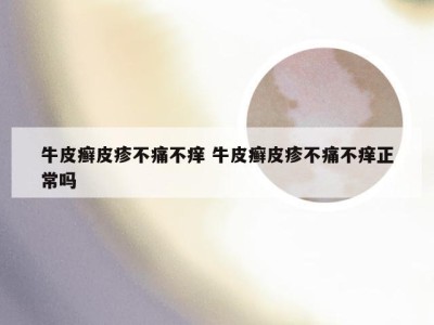 牛皮癣皮疹不痛不痒 牛皮癣皮疹不痛不痒正常吗