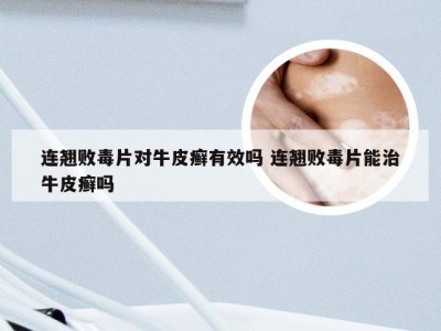 连翘败毒片对牛皮癣有效吗 连翘败毒片能治牛皮癣吗