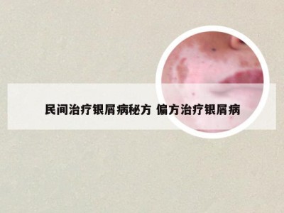 民间治疗银屑病秘方 偏方治疗银屑病