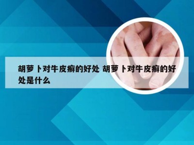 胡萝卜对牛皮癣的好处 胡萝卜对牛皮癣的好处是什么