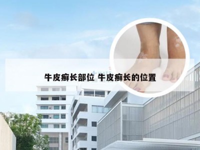 牛皮癣长部位 牛皮癣长的位置