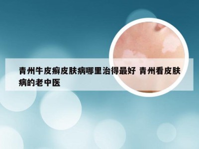 青州牛皮癣皮肤病哪里治得最好 青州看皮肤病的老中医