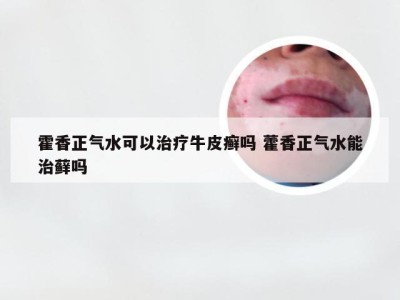 霍香正气水可以治疗牛皮癣吗 藿香正气水能治藓吗