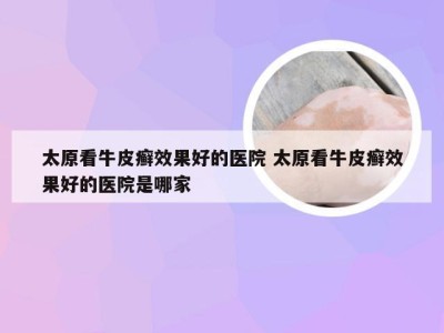 太原看牛皮癣效果好的医院 太原看牛皮癣效果好的医院是哪家