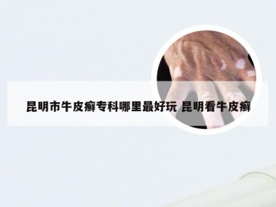 昆明市牛皮癣专科哪里最好玩 昆明看牛皮癣