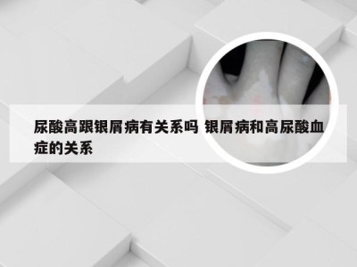尿酸高跟银屑病有关系吗 银屑病和高尿酸血症的关系