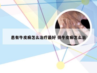 患有牛皮癣怎么治疗最好 得牛皮癣怎么治