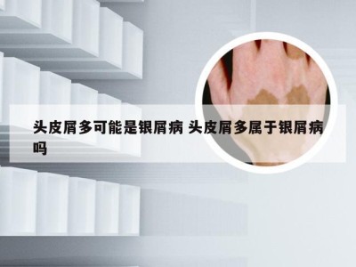 头皮屑多可能是银屑病 头皮屑多属于银屑病吗