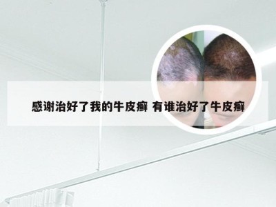 感谢治好了我的牛皮癣 有谁治好了牛皮癣