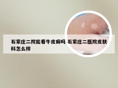 石家庄二院能看牛皮癣吗 石家庄二医院皮肤科怎么样