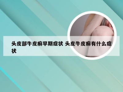 头皮部牛皮癣早期症状 头皮牛皮癣有什么症状