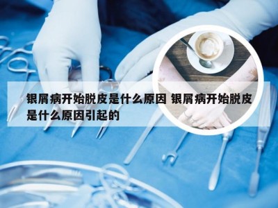 银屑病开始脱皮是什么原因 银屑病开始脱皮是什么原因引起的