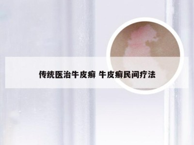传统医治牛皮癣 牛皮癣民间疗法