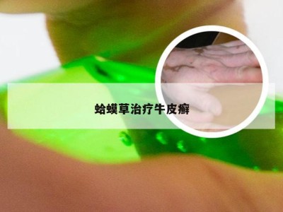 蛤蟆草治疗牛皮癣