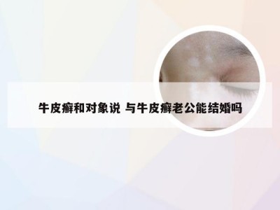 牛皮癣和对象说 与牛皮癣老公能结婚吗