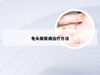 龟头银屑病治疗方法