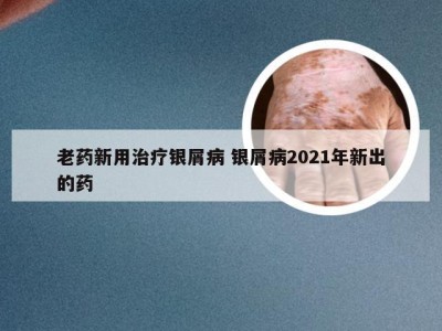 老药新用治疗银屑病 银屑病2021年新出的药