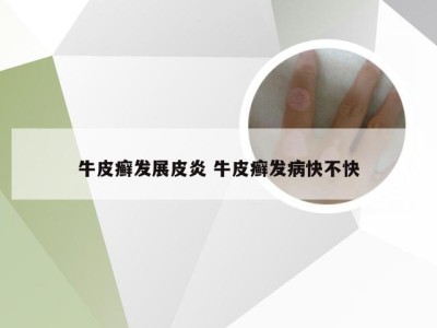牛皮癣发展皮炎 牛皮癣发病快不快