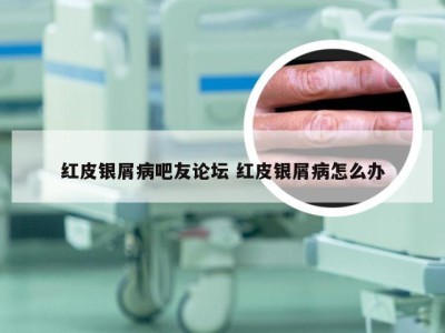 红皮银屑病吧友论坛 红皮银屑病怎么办