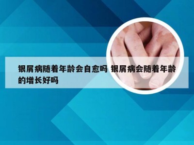 银屑病随着年龄会自愈吗 银屑病会随着年龄的增长好吗