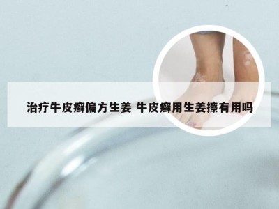 治疗牛皮癣偏方生姜 牛皮癣用生姜擦有用吗