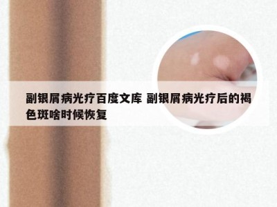 副银屑病光疗百度文库 副银屑病光疗后的褐色斑啥时候恢复
