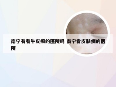 南宁有看牛皮癣的医院吗 南宁看皮肤病的医院