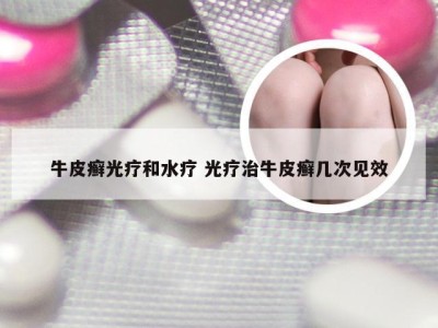 牛皮癣光疗和水疗 光疗治牛皮癣几次见效
