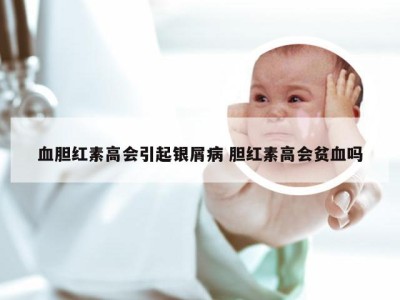 血胆红素高会引起银屑病 胆红素高会贫血吗