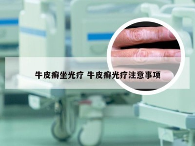 牛皮癣坐光疗 牛皮癣光疗注意事项
