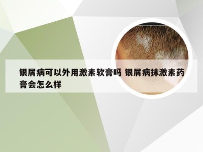 银屑病可以外用激素软膏吗 银屑病抹激素药膏会怎么样