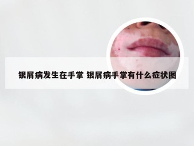 银屑病发生在手掌 银屑病手掌有什么症状图