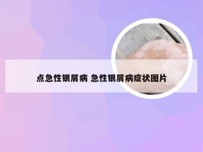 点急性银屑病 急性银屑病症状图片