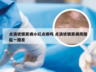 点滴状银屑病小红点痒吗 点滴状银屑病周围起一圈皮