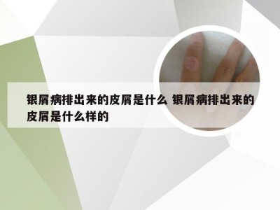 银屑病排出来的皮屑是什么 银屑病排出来的皮屑是什么样的