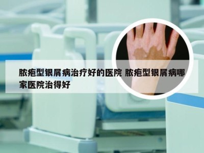 脓疱型银屑病治疗好的医院 脓疱型银屑病哪家医院治得好