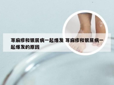 荨麻疹和银屑病一起爆发 荨麻疹和银屑病一起爆发的原因