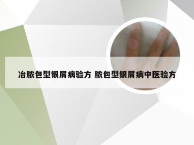 冶脓包型银屑病验方 脓包型银屑病中医验方