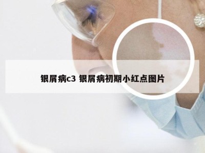 银屑病c3 银屑病初期小红点图片