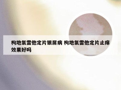枸地氯雷他定片银屑病 枸地氯雷他定片止痒效果好吗