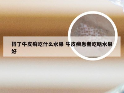 得了牛皮癣吃什么水果 牛皮癣患者吃啥水果好