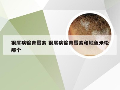 银屑病输青霉素 银屑病输青霉素和地色米松那个