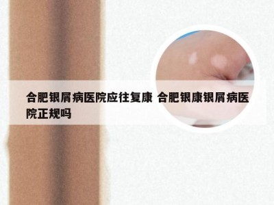 合肥银屑病医院应往复康 合肥银康银屑病医院正规吗