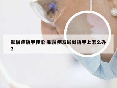 银屑病指甲传染 银屑病发展到指甲上怎么办?