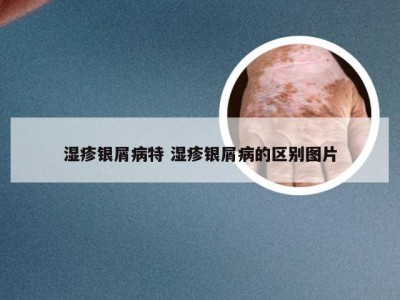 湿疹银屑病特 湿疹银屑病的区别图片