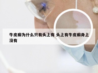 牛皮癣为什么只有头上有 头上有牛皮癣身上没有